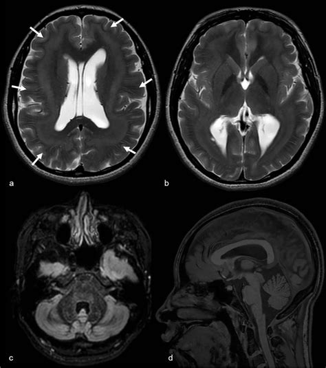 A Year Old Female With Subcortical Band Heterotopia Grade Subtype