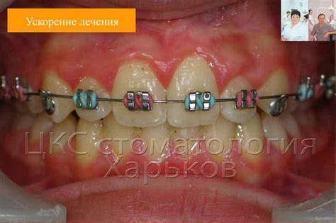 Лингвальные кнопки. Стоматология в Харькове