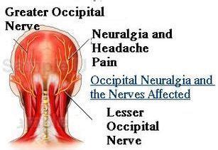 Occipital Neuralgia - Symptoms, Treatment, Causes, Surgery