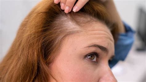 Androgenetic Alopecia Symptoms In Women