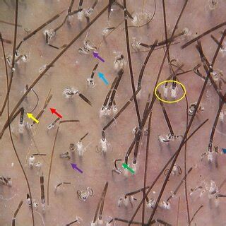 Trichoscopic Evaluation Of Tinea Capitis