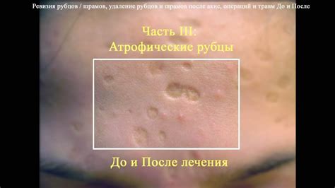 Часть III: Атрофические рубцы и рубцы после акне до и после лечения ...