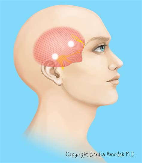 Surgical Management Of Migraine Headaches Intechopen