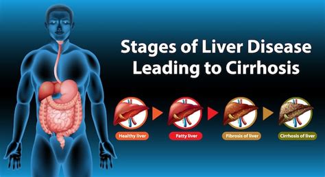 Liver Cirrhosis Final Stages