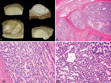 Figure 1 From Uterine Tumors Resembling Ovarian Sex Cord Tumors