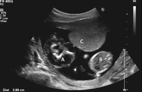 Ultrasound image pre-procedure.