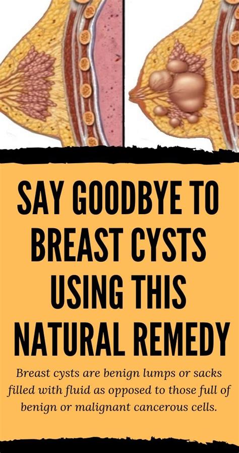 How To Dissolve Cysts In Breast Skin Cysts Sebaceous Cyst They Feel Smooth Or Rubbery And