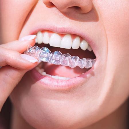 Maya Aligner EXPRESS Clinicile DR ALECU