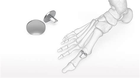 Osteomed Hemi Great Toe Implant Acumed