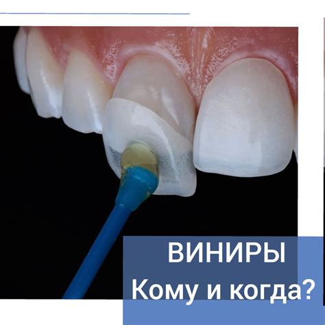 Что такое виниры и кому они подойдут - стоматология Орбиталь