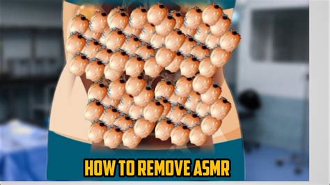 Asmr Remove Maggot Worm Infected Belly Deep Cleaning Animation