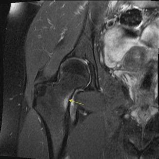 Femoral Neck Stress Fracture Mri