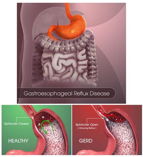 Nissen Fundoplication Lap Nissen By Dr David W Ford