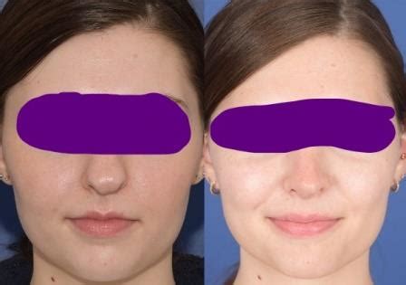 Rhinoplasty