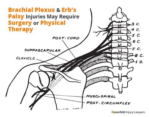 Chicago Erbs Palsy Lawyer Rosenfeld Injury Lawyers LLC