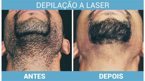 Depilação A Laser Para Homens Tudo O Que Você Precisa Saber