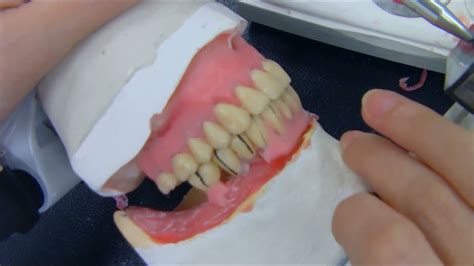 Prótese Total para iniciantes Parte 4 Montagem de Dentes Posteriores