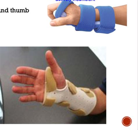 Most Common Splints Flashcards Quizlet