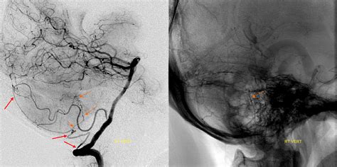 Posterior Meningeal Artery | neuroangio.org