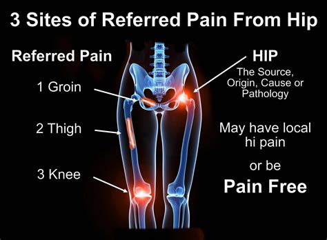 Referred Pain - Back Care Clinic