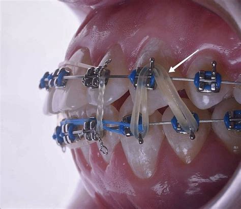 How Do Ortho Elastics Work At Larry Howell Blog