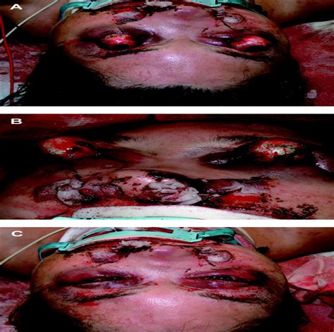 Bilateral Traumatic Globe Subluxation Ophthalmic Plastic