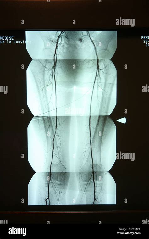 Arterien Der Unteren Extremit T Fotos Und Bildmaterial In Hoher