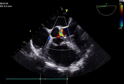 A Case Report：ultrasound Guided One Stop” Transcatheter Aortic Valve