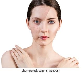 Young Girl Acne Before After Treatment Stock Photo 548167054 | Shutterstock