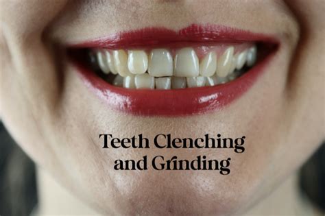 Teeth Grinding Clenching Dental Hygiene Resource