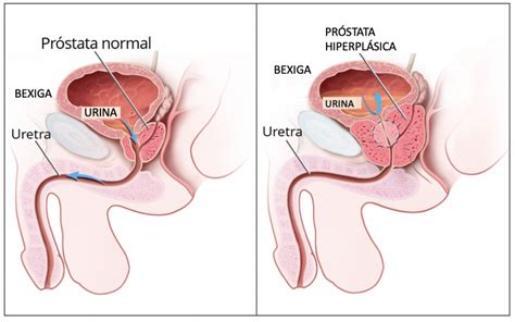 Hiperplasia Prostática Benígna O Que é Sintomas Diagnóstico