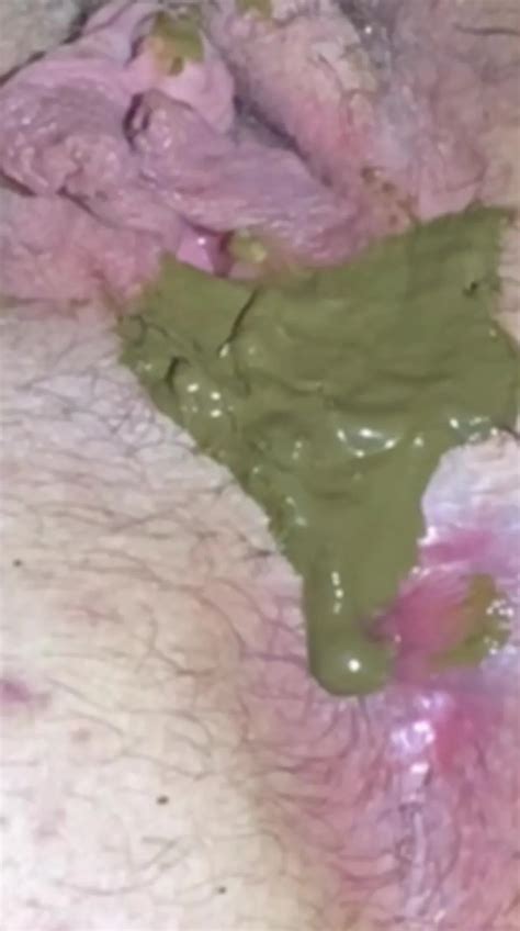 Worms Anal Maggots 1 ThisVid