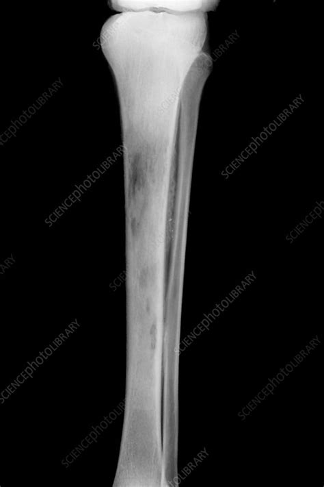 Osteomyelitis X Ray Features