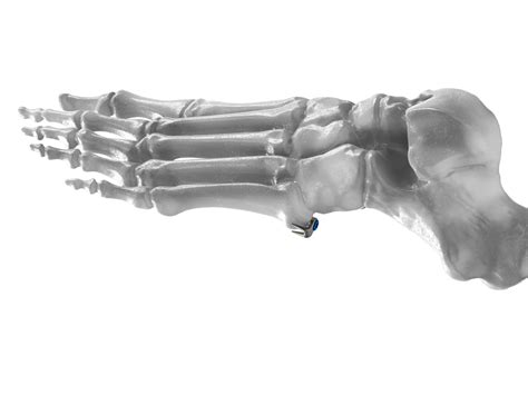 Jones Fracture — CENTRIC MEDICAL