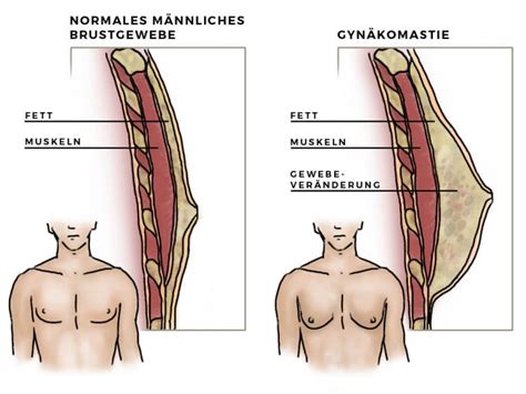 Gynäkomastie Brustverkleinerung für Männer in Köln
