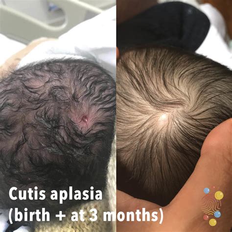 Cutis Aplasia Skin Deep