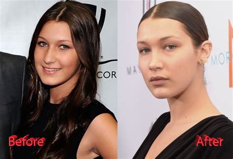 Bella Hadid Nose Job Plastic Surgery: True or Not?