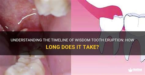 Understanding The Timeline Of Wisdom Tooth Eruption How Long Does It Take Medshun