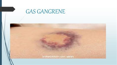 Gas Gangrenepptx Free Download