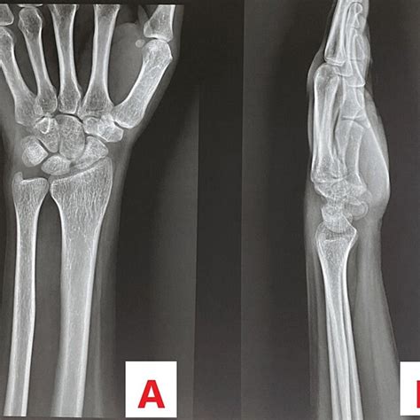 Plain Radiograph Of The Left Wrist Joint Showing No Abnormality A