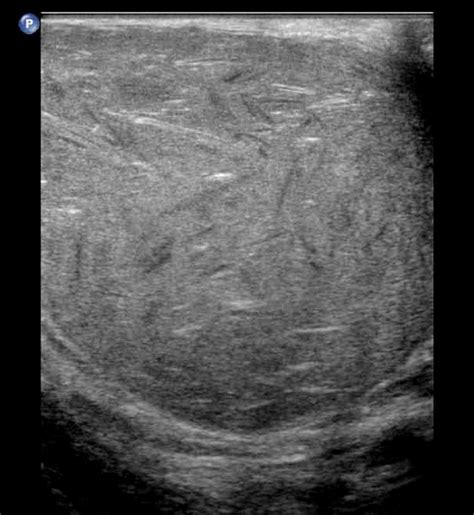 A Scrotal Ultrasonography Showed A 5 Cm3 Cm5 Cm Heterogeneous