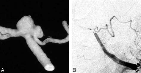 Acutely Ruptured Pica Aneurysm In A 46 Year Old Woman A 3d Left