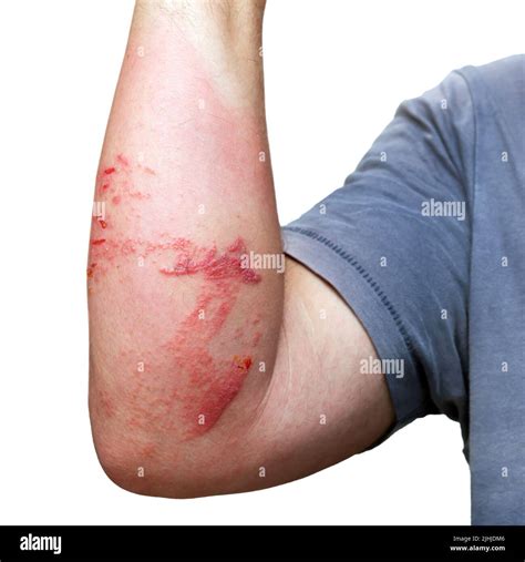 Brazo Masculino Con Quemaduras En La Piel Y Lesiones Causadas Por