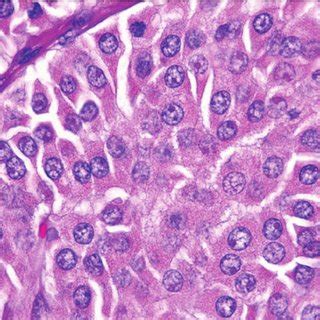 (PDF) Hurthle cell carcinoma of the thyroid