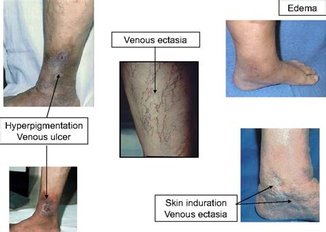 Thrombophlebitis Of The Lower Extremities