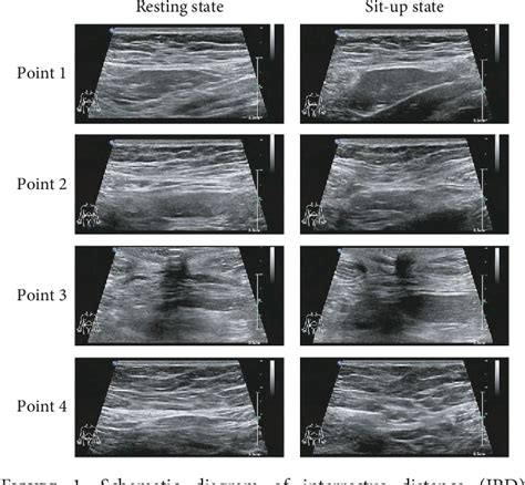 Figure 1 From Ultrasonic Characteristics Of Diastasis Recti Abdominis In Early Postpartum