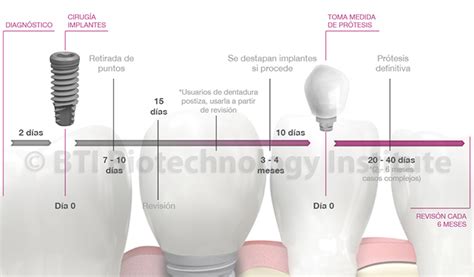 Descubre Cuales Son Las Fases Y El Tratamiento De Los Implantes Bti