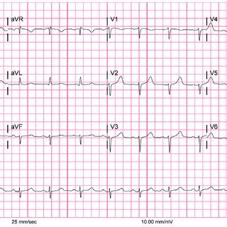 Electrocardiography Performed The Morning After Admission Showed Sinus