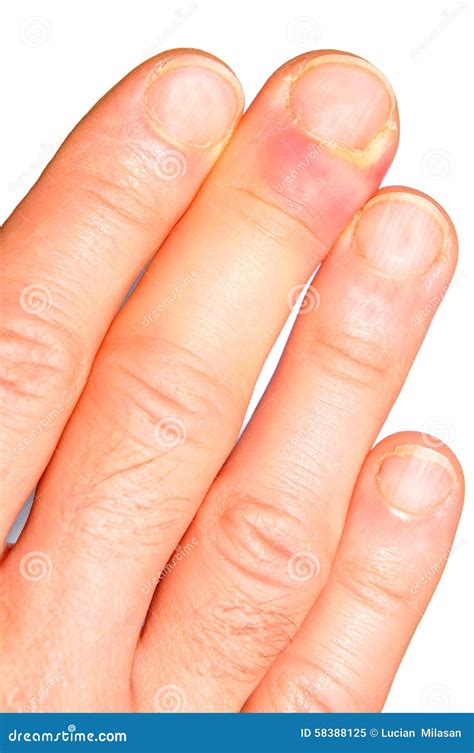 Hand infection stock image. Image of medical, closeup - 58388125