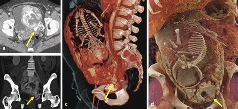 31 Year Old Patient With Placenta Percreta Diagnosed On Download Scientific Diagram